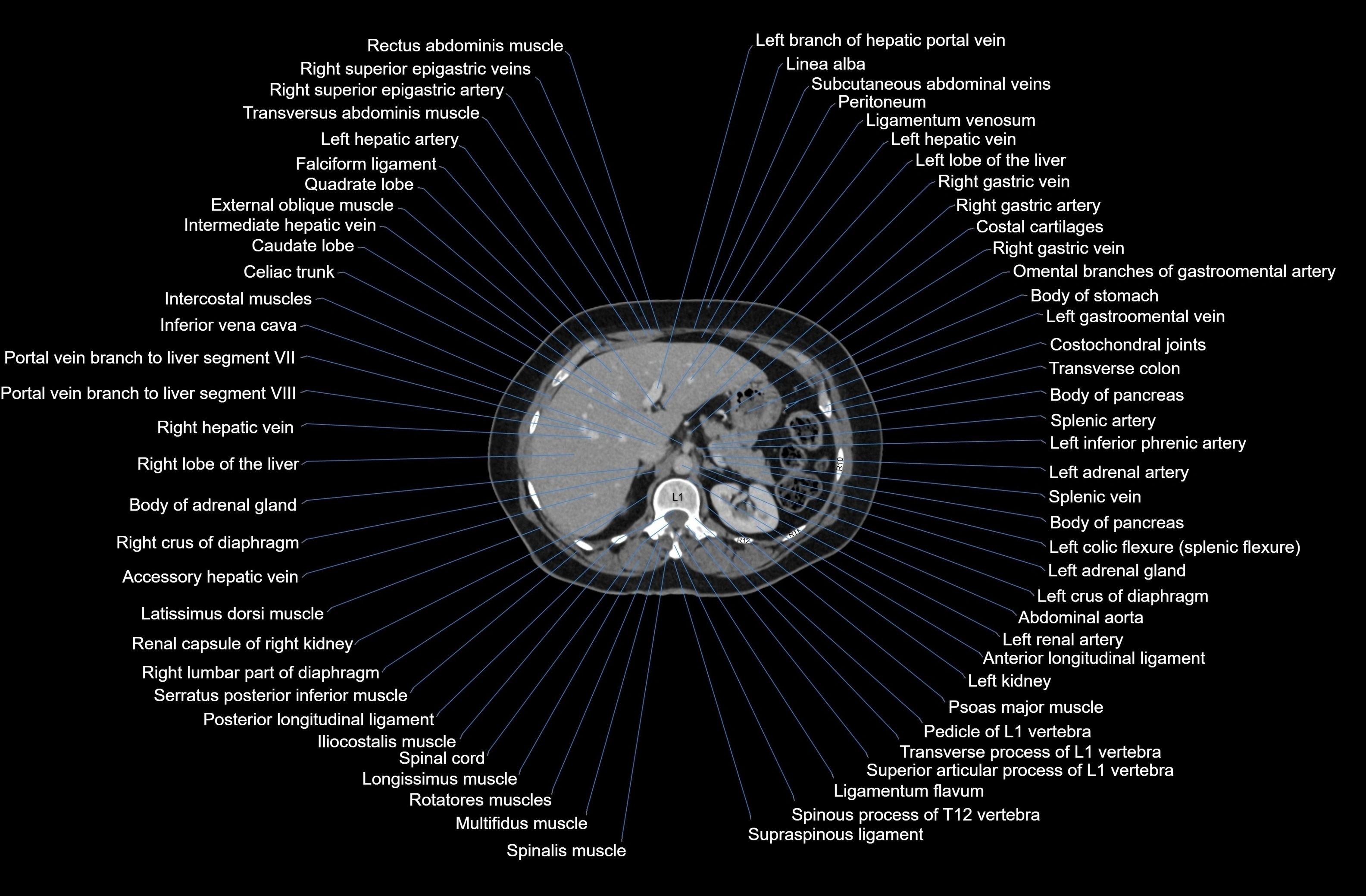CT Abdomen axial cross sectional anatomy labelled radiology image-00024.webp
